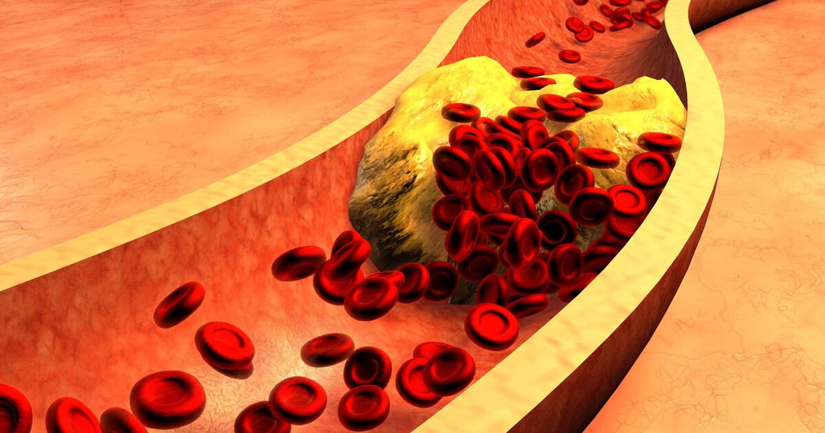 Seven-day cholesterol-lowering meal plan by cardiac experts may reduce statin dependency