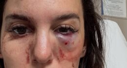 Disney star reveals horrific eye injury after getting shot saying she almost went BLIND and has lead stuck in her skull