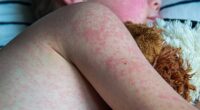 Measles outbreak reaches worrying milestone as doctors reveal what 99.2% of infected people have in common