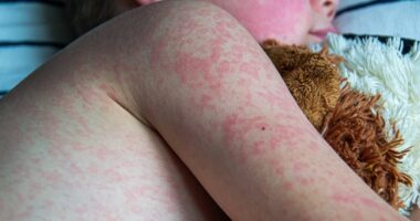 Measles outbreak reaches worrying milestone as doctors reveal what 99.2% of infected people have in common